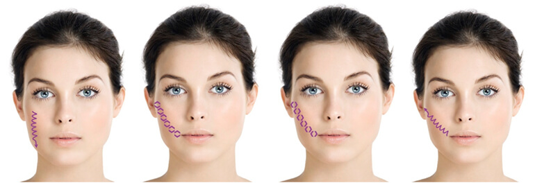 institut esthederm esthelift 17 mk